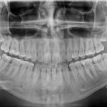 A cosa serve la radiografia dei denti?