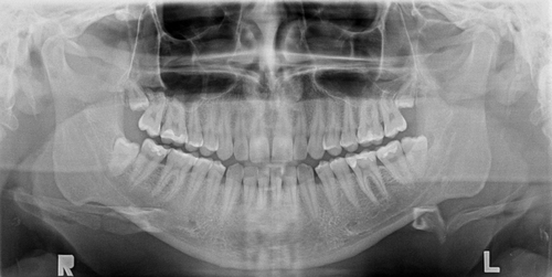 A cosa serve la radiografia dei denti?